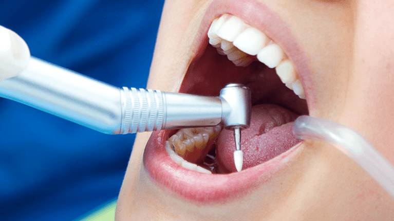 root canal